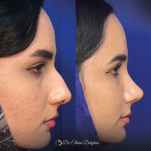 rhinoplasty-38