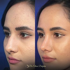 rhinoplasty-39
