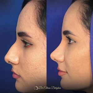 rhinoplasty-40