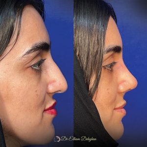 rhinoplasty-41