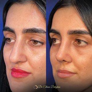 rhinoplasty-42