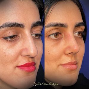 rhinoplasty-43