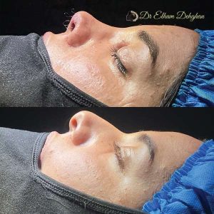 rhinoplasty-45