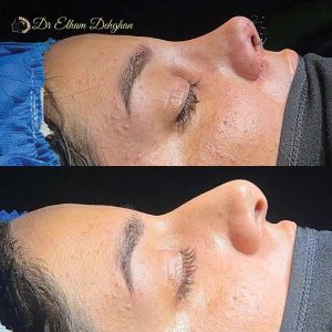rhinoplasty-46