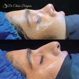 rhinoplasty-47
