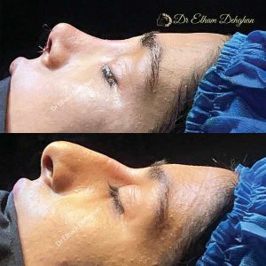 rhinoplasty-48