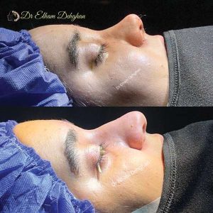 rhinoplasty-49