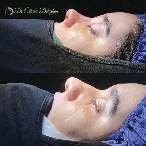 rhinoplasty-50