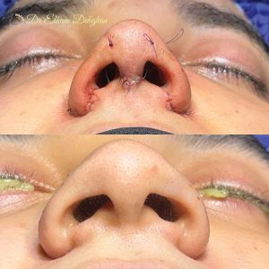 rhinoplasty-51