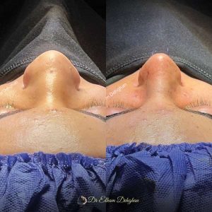 rhinoplasty-52