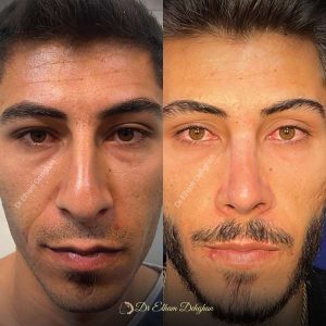 rhinoplasty-53