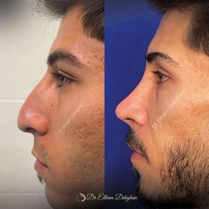 rhinoplasty-54