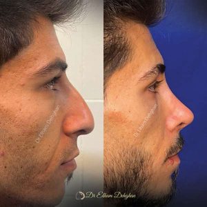 rhinoplasty-55