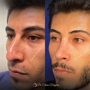 rhinoplasty-56
