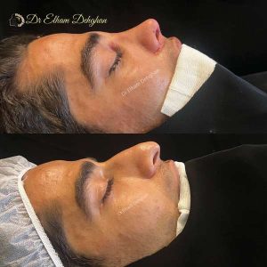 rhinoplasty-57