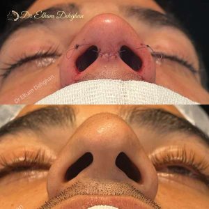 rhinoplasty-58