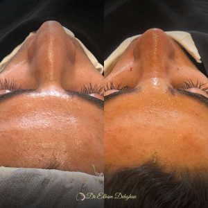 rhinoplasty-59