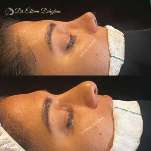rhinoplasty-60