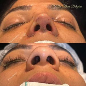 rhinoplasty-61