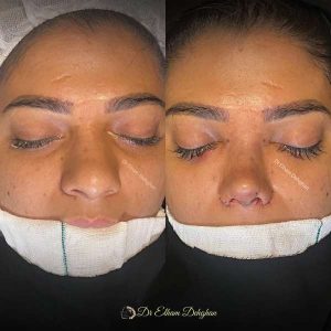 rhinoplasty-62