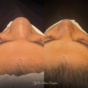 rhinoplasty-63