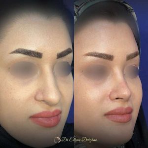 rhinoplasty-64