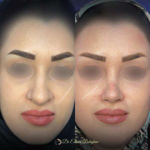 rhinoplasty-65