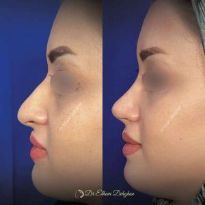 rhinoplasty-66